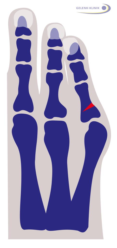 Schneiderballen vor Osteotomie mit Markierung des zu entnehmenden Knochenkeils