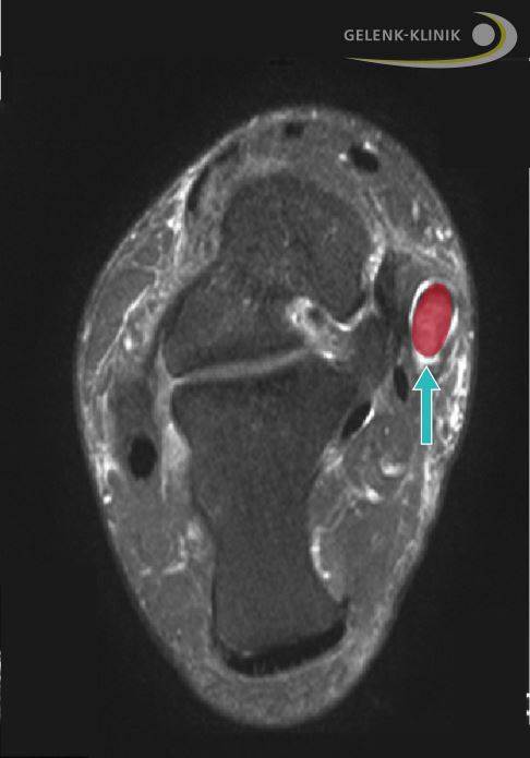 MRT-Bild von oben: Die Tibialis-posterior-Sehne dieses Patienten ist stark verdickt (rot). In ihrer Sehnenscheide hat sich Flüssigkeit angesammelt, was auf eine Entzündung der Sehne hindeutet. Eine geschwächte Tibialis-posterior-Sehne begünstigt die Entstehung eines Knick-Senkfußes. © Gelenk-Klinik MRT: Knick-Senkfuß mit Schwäche der Tibialis-posterior-Sehne