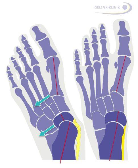 Links: Knick-Senkfuß mit schwacher Tibialis-posterior-Sehne (gelb) und resultierender Fußfehlstellung. Rechts: Zustand nach Sehnentransplantation und Wiederausrichten des Fußgewölbes. © Gelenk-Klinik Sehnenfunktion bei Knick-Senkfuß