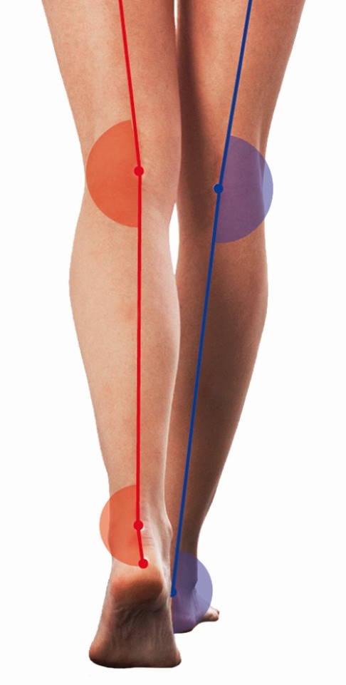 Anhand des Gangbilds des Patienten erkennt der Orthopäde mögliche Fehlstellungen. © DIERS videobasierte Ganganalyse