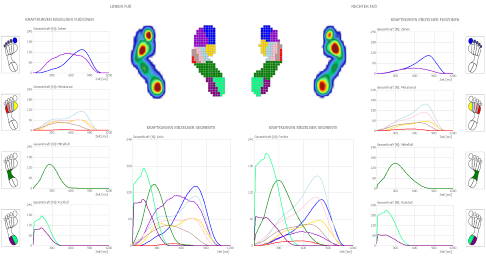 Knick-Senkfuß in der Ganganalyse: Der Orthopäde erhält wichtige Informationen zur Fußbelastung und zum Gangbild. © Gelenk-Klinik Auswertung Ganganalyse: Knick-Senkfuß