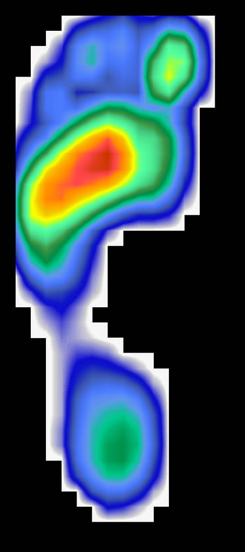 Fußdruckmessung bei Spreizfuß