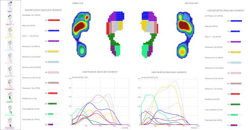 Auswertung der Ganganalyse bei einem Spreizfuß