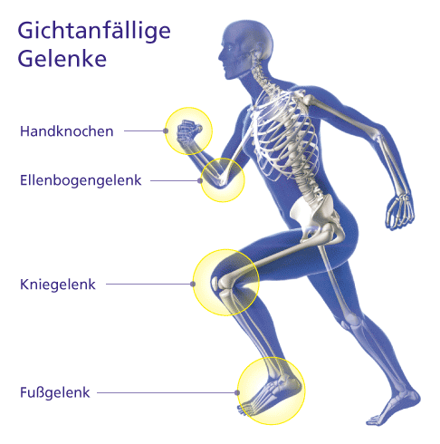 Neben dem Großzehengrundgelenk sind Fuß- oder Sprunggelenke, Knie, Hand- und Ellenbogengelenk häufig von Gicht betroffen. © Gelenk-Klinik Darstellung der gichtanfälligen Gelenke