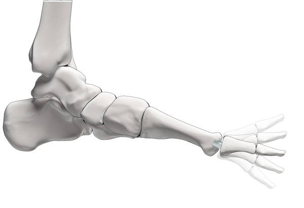 Die CARTIVA®-Teilprothese besteht aus einem elastischen, wasserbindenden Kunststoff mit knorpelähnlichen Eigenschaften. Das elastische Implantat wird im Knochen des 1. Zehenstrahls (Großzehe) verankert. Der 1. Zehenknochen mit der Gelenkpfanne als Gelenkpartner bleibt unverändert. © CARTIVA Inc. Fuß mit CARTIVA®-Teilprothese