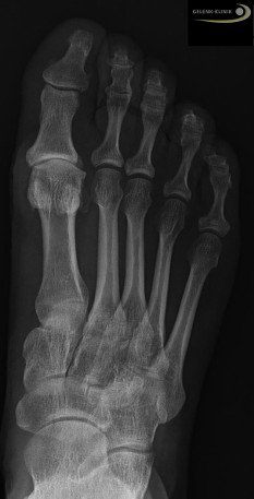 Röntgenbild eines Hallux rigidus: Deutlich sichtbar ist der verschmälerte Gelenkspalt im Großzehengrundgelenk und eine seitliche Abweichung des großen Zehs. © Gelenk-Klinik Röntgenbild eines Hallux rigidus