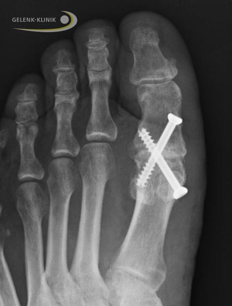 Röntgenbild einer Arthrodese des Großzehengrundgelenks: Fixierung des Grundgliedes und des Mittelfußknochens mit gekreuzten Schrauben. © Gelenk-Klinik Röntgenbild einer Arthrodese