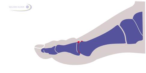 Schematisches Bild eines Hallux rigidus: Deutlich sichtbar ist der verschmälerte Gelenkspalt des arthrotischen Gelenks. Im fortgeschrittenen Stadium bilden die Gelenkflächen an den Seiten Knochenanbauten (Osteophyten) aus (rot markiert), um die veränderte Druckverteilung im Gelenk zu kompensieren. © Gelenk-Klinik Hallux rigidus mit Osteophyten