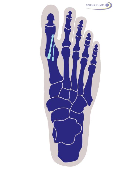 Der Hallux rigidus kann durch eine Versteifung (Arthrodese) behandelt werden. Nach der Entfernung des abgenutzten Großzehengelenks verbindet der Orthopäde die Knochen durch Schrauben. Innerhalb von 6–8 Wochen können die Gelenkflächen knöchern zusammenwachsen. © Dr. Thomas Schneider Arthrodese des Hallux rigidus