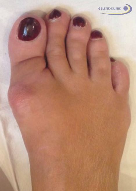 Als Hallux rigidus bezeichnet man eine Arthrose im Großzehengrundgelenk. © Gelenk-Klinik Hallux rigidus (Arthrose des Großzehengrundgelenks)