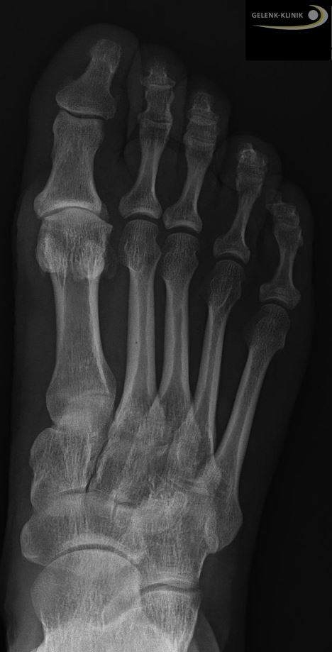 Hallux rigidus im Röntgenbild: Der Gelenkspalt des Großzehengrundgelenks ist aufgrund des fehlenden Knorpels stark verschmälert. © Gelenk-Klinik Hallux rigidus im Röntgenbild