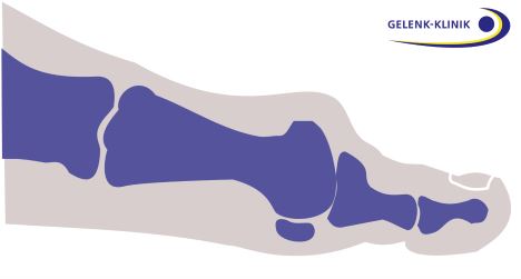 Hallux rigidus vor der Cheilektomie