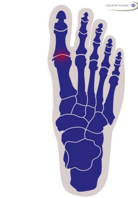 Die Arthrose des Großzehengrundgelenks (GZG) kann durch eine Versteifung (Arthrodese) behandelt werden. © Gelenk-Klinik Hallux rigidus