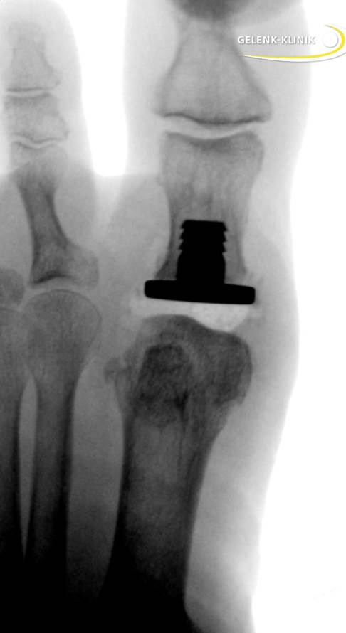 Röntgenbild einer Hemiprothese zur Behandlung einer Arthrose des Großzehengrundgelenks (Hallux rigidus). © Gelenk-Klinik Röntgenbild einer Hemiprothese bei Hallux rigidus