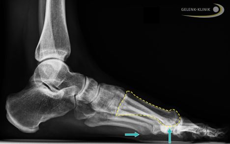 Ein Risikofaktor für die Entstehung der Arthrose im Großzehengrundgelenk scheint eine Fehlstellung des Mittelfußknochens zu sein. Beim sogenannten Metatarsus primus elevatus ist der Mittelfußknochen der großen Zehe im Vergleich zu den anderen Mittelfußknochen höhergestellt (gelbe Markierung). © Gelenk-Klinik Röntgenbild eines Metatarsus elevatus (Hochstellung des ersten Mittelfußknochens)
