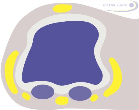 Eine veränderte Fußstellung kann zu einer Reizung an den unter dem Mittelfußkopf liegenden Sesambeinen führen. Sie dienen als Abstandhalter zu den Sehnen (gelb eingezeichnet). © Dr. Thomas Schneider Gelenk zwischen Sesambeinen und Mittelfußknochen