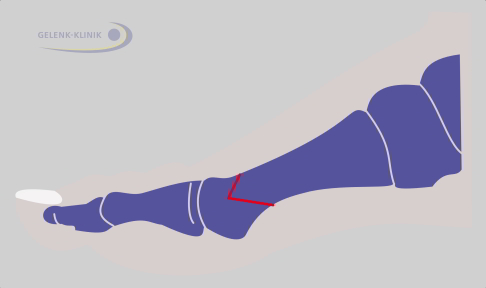 Schema: Planung einer Chevron-Osteotomie