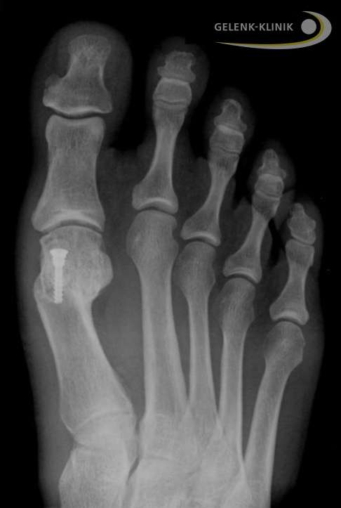 Hallux valgus, korrigiert durch Chevron-Osteotomie. Eine selbstschneidende Titanschraube fixiert den Mittelfußknochen des großen Zehs in der neuen Position. © FH-Orthopaedics Hallux valgus nach Chevron-Osteotomie
