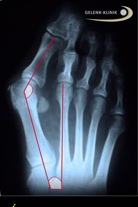 Schwerer Hallux valgus im Röntgen: Winkel markieren das Ausmaß der Fehlstellung. © Gelenk-Klinik Röntgenbild eines Hallux valgus