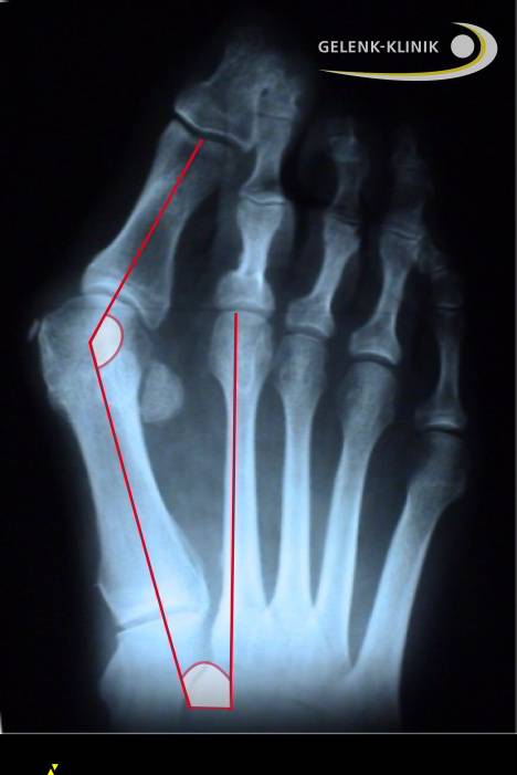 Röntgenbild eines schweren Hallux valgus