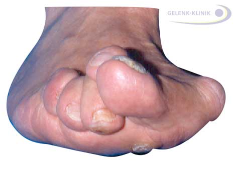 Schwere Hallux valgus-Fehlstellung mit Hammerzehen von vorne: Der Hallux valgus verdrängt die benachbarten Zehen. Deutlich sichtbar ist die Hornhaut unter den Kleinzehen als Folge der Belastungsumverteilung – weg von der Großzehe, hin zu den Kleinzehen. © Gelenk-Klinik Fuß mit Fehlstellung von vorne