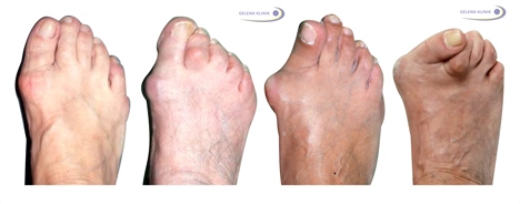 Stadien des Hallux valgus: Links erkennt man die normale Großzehenstellung, wobei ein Winkel von bis zu 10° noch als normal gilt. Ein schwerer Hallux valgus liegt ab einem Großzehenwinkel von 40°–45° vor. © Gelenk-Klinik 4 Stadien des Hallux valgus