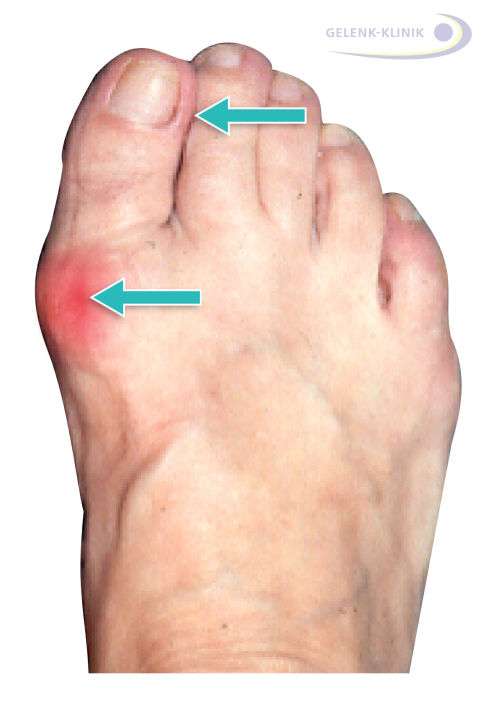 Hallux valgus mit leichter Fehlstellung: Deutlich erkennbar ist die seitliche Abweichung der Großzehe und die Druckstelle am Großzehengrundgelenk. © Gelenk-Klinik Hallux valgus mit leichter Fehlstellung