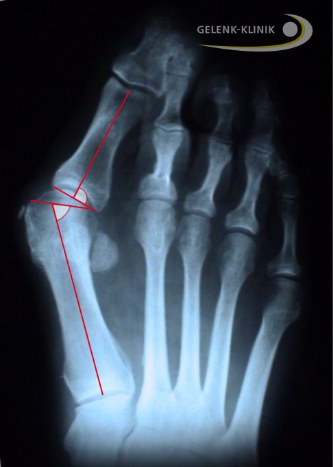 Fuß eines Patienten mit Hallux valgus-Fehlstellung. Deutlich sichtbar ist die nach außen gerichtete Großzehe. Die Sesambeinchen der Großzehenbeugersehne sieht man unterhalb des Großzehengrundgelenks. Sie liegen nicht mehr symmetrisch, sondern sind seitlich verschoben. Der Sehnenzug verläuft daher nicht mehr parallel zur Richtung des Zehenstrahls. © Gelenk-Klinik Röntgenbild des Hallux valgus – Überbein, Ballenfuß
