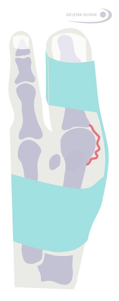 Die Hallux valgus-Orthese entspannt die Gelenkkapsel (rot) durch die Begradigung der Großzehe. © Gelenk-Klinik Wirkung der Hallux valgus-Orthese auf die Gelenkkapsel