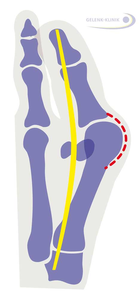 Die Sehne des Großzehenbeugers (gelb) verläuft beim Hallux valgus nicht mehr parallel zum 1. Zehenstrahl. Die Sesambeine liegen nicht mehr rechts und links der Großzehe, sondern nach außen verschoben. Auf diese Weise dreht der Sehnenzug die Zehe aus dem Gelenk. Die Gelenkkapsel (rot) wird gedehnt. © Gelenk-Klinik Sehnenverlauf des Großzehenbeugers bei Hallux valgus