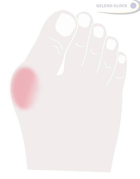 Charakteristisch für den Hallux valgus ist der Knick der Großzehe nach außen. Durch zunehmenden Konflikt mit dem Schuh entsteht am Grundgelenk durch Reibung eine Entzündung des Schleimbeutels (Bursa). © Gelenk-Klinik Hallux valgus mit entzündetem Schleimbeutel