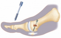 Chevron-Osteotomie: Nach einem Schnitt im Knochen richtet der Arzt mithilfe einer Osteotomie die Richtung des Zehenstrahls dauerhaft neu aus. Dies kann den Hallux valgus nach der Einheilung dauerhaft beseitigen. © FH Orthopaedics Umstellung (Osteotomie) des Zehenknochens