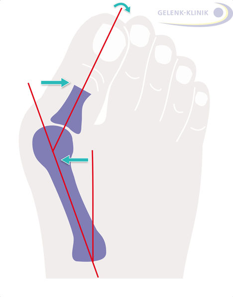 Die Abweichung der Großzehe von der Normalrichtung zeigt dem Arzt den Grad der Hallux valgus-Fehlstellung. © Gelenk-Klinik Winkelmessung zur Feststellung des Grades der Fehlstellung