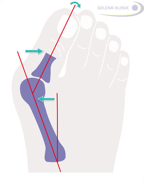 Der Hallux valgus ist eine weit verbreitete Fehlstellung, bei der die Großzehe nach außen abweicht. © Gelenk-Klinik Der Hallux valgus ist eine weit verbreitete Fehlstellung der Großzehe.