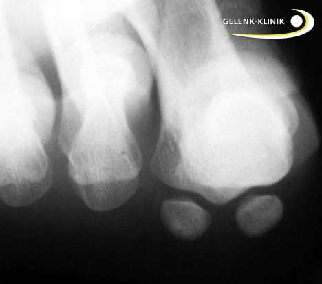 Das Röntgenbild zeigt die zwei Sesambeine unter den Mittelfußköpfchen der Großzehe. © Gelenk-Klinik Röntgen: Sesambeine