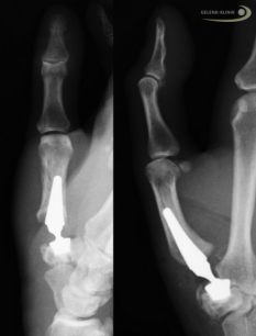 Das Röntgenbild zeigt eine Daumensattelgelenksprothese mit Kugelgelenk. © Gelenk-Klinik Prothese des Daumensattelgelenks