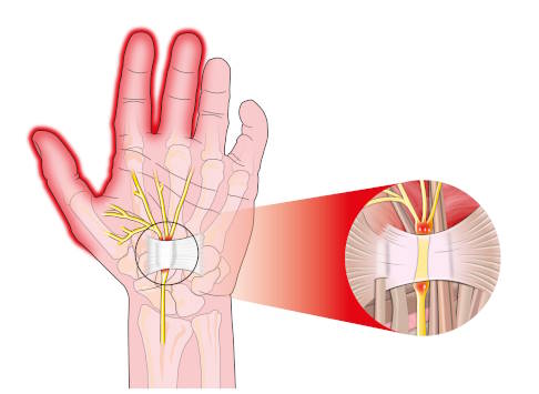 Beim Karpaltunnelsyndrom engt das Karpalband den am Handgelenk verlaufenden Nervus medianus ein. Im Rahmen einer Operation wird das Band durchtrennt und der Nerv auf diese Weise freigelegt. © alexonline, Adobe Anatomie der Hand mit Karpalband und Nervus medianus