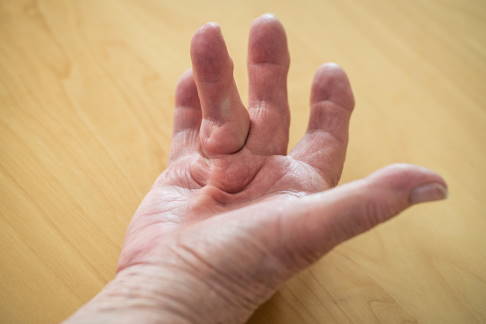 Dupuytren-Kontraktur: Die Finger können aufgrund einer Wucherung von Bindegewebe nicht mehr ausgestreckt werden. © mbbirdy, istock Beugekontraktur bei Morbus Dupuytren