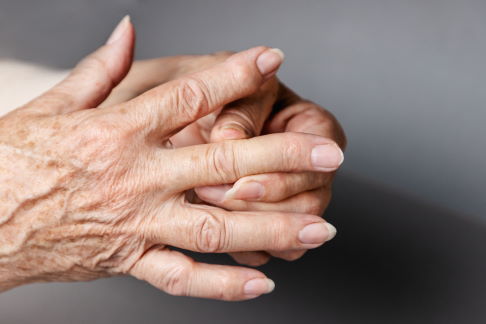 Bei Fingerarthrose schmerzen die einzelnen Gelenke, die teilweise geschwollen und gerötet sein können. © _KUBE_, Adobe Patient mit Fingerarthrose