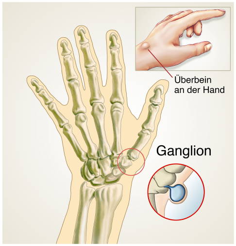 In den meisten Fällen bildet sich ein Ganglion am Handgelenk. © Henrie, Adobe Ganglion an der Hand