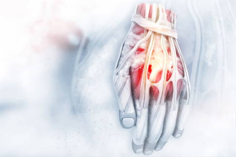 Sehnenscheiden umhüllen die Sehnen der Hand. Diese übertragen die Kraft vom Unterarm in Richtung Finger. Zur besseren Gleitfähigkeit sind die Sehnenscheiden mit Gelenkschmiere (Synovialflüssigkeit) gefüllt. Bei Überlastung können sich die Sehnen entzünden und kleine Verletzungen an den Sehnenscheiden verursachen. Beugen und Strecken der Finger ist dann schmerzhaft und nur noch eingeschränkt möglich. © Crystal light, Adobe Stock Hand mit Sehnen und den umhüllenden Sehnenscheiden