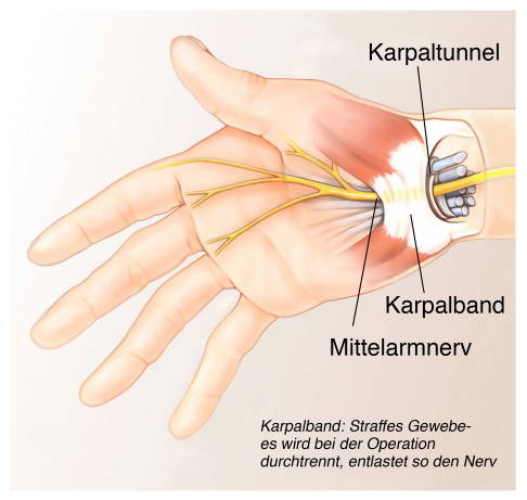 Das Karpaltunnelsyndrom ist eins der häufigsten Enpasssyndrome: Es kommt zu einer Einengung des Mittelarmnervs unter dem Karpalband. © Henrie, Adobe Stock Anatomie des Karpaltunnels
