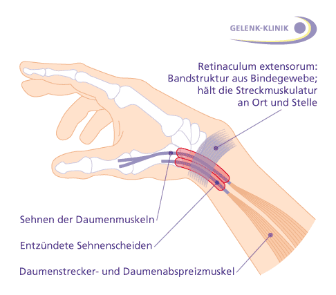 Bei der Quervain-Krankheit (Tendovaginitis de Quervain) bilden sich an Daumenmuskeln und ihren umhüllenden Sehnenscheiden entzündliche Veränderungen. Auslöser sind meist eintönige, häufige Bewegungsabläufe. Frauen sind von der Quervain-Krankheit häufiger als Männer betroffen. © Gelenk-Klinik Hand mit eingezeichneten Daumensehnen und Sehnenscheiden
