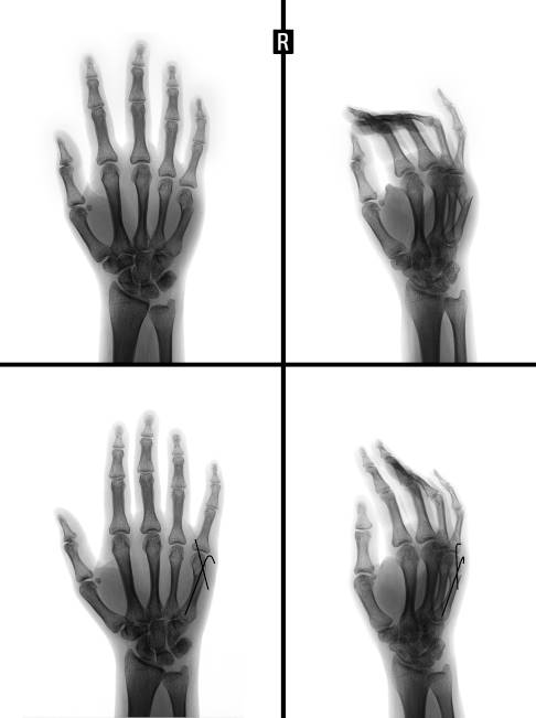 Oben: ungerichteter Bruch des 5. Metatarsalknochens. Unten: Reposition des Knochens mittels Osteosynthese. © vanzittoo, Adobe Reposition des 5. Metatarsalknochens