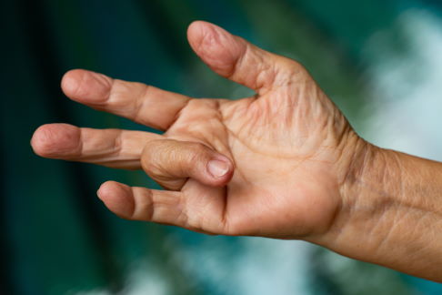 Die empfindlichen Beugesehnen der Finger können durch chronische Überlastung verdicken. Als Folge gleitet die betroffene Sehne nicht mehr geschmeidig am Ringband vorbei: Ein Schnappfinger entsteht. © eyepark, Adobe Schnellender Finger