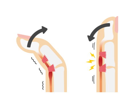 Bei einem Schnappfinger ist das Strecken des Fingers blockiert, da die verdickte Fingersehne (rot) nicht durch das quer verlaufende Ringband (rosa) gleiten kann. © barks, Adobe Schnellender Finger
