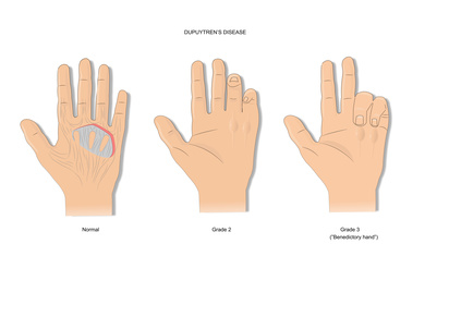 Die Beugesehnen der Handinnenfläche können sich durch Überlastung entzündlich verdicken. Dann gleitet die Beugesehne nicht mehr problemlos durch ihr Ringband, das sie nahe am Fingerknochen führt. Die knotenartig verdickte Sehne kann zwar noch gebeugt, aber nur unter zusätzlichem Kraftaufwand wieder gestreckt werden: Ein schnellender Finger (Tendovaginitis stenosans) entsteht. Das linke Bild zeigt die Streckfähigkeit der Finger bei Gesunden. Im mittleren Bild ist die Streckung der Finger nach Beugung nur noch teilweise möglich (Grad 2), rechts ist eine aktive Streckung unmöglich (Grad 3).© ellepigrafica, Adobe Stock Morbus Dupuytren im Vergleich zur gesunden Hand