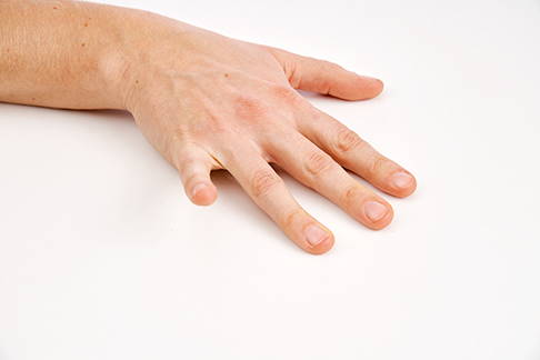 Fingermobilisation kleiner Finger. © Gelenk-Klinik Fingermobilisation kleiner Finger