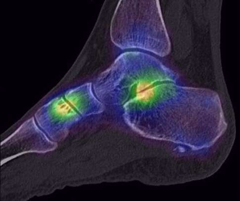 SPECT-Aufnahme des Hohlfußes mit dem CT. Das SPECT (Einzelphotonen-Emissionscomputertomographie) stellt Stoffwechselaktivitäten im Knochen genau dar. So können bei der Planung der Therapie bereits Arthrose der Fußknochen oder Sprunggelenke bzw. die Folgen von Impingements berücksichtigt werden. © Gelenk-Klinik SPECT-Aufnahme des Hohlfußes