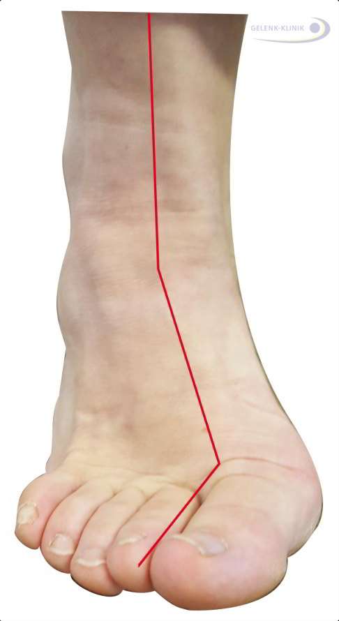 Schema des Hohlfußes von vorne: Am Fuß zeigt die rote Linie eine typische Verdrehung von Rückfuß, Mittelfuß und Vorfuß bei Hohlfußfehlstellung. © Gelenk-Klinik Hohlfuß von vorne